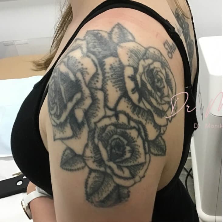Before: Tattoo Removal Before & After Patient #1672
