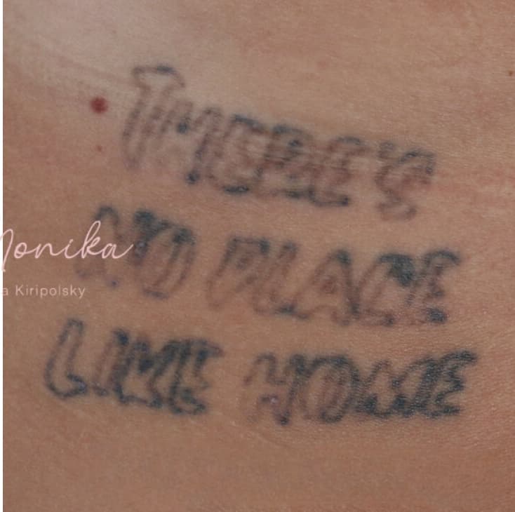 After: Tattoo Removal Before & After Patient #1674