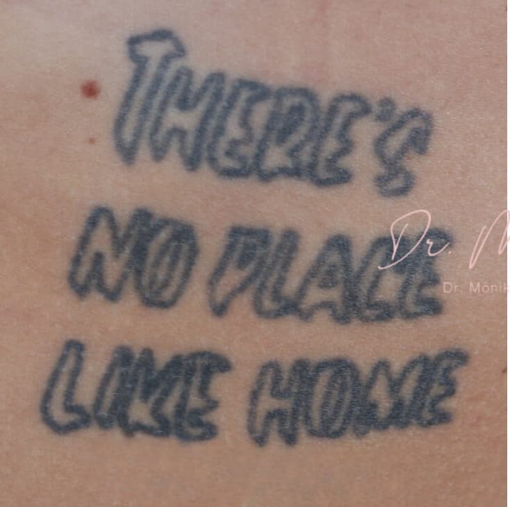 Before: Tattoo Removal Before & After Patient #1674