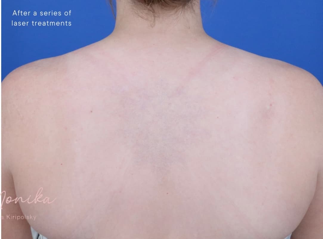 After: Tattoo Removal Before & After Patient #1887