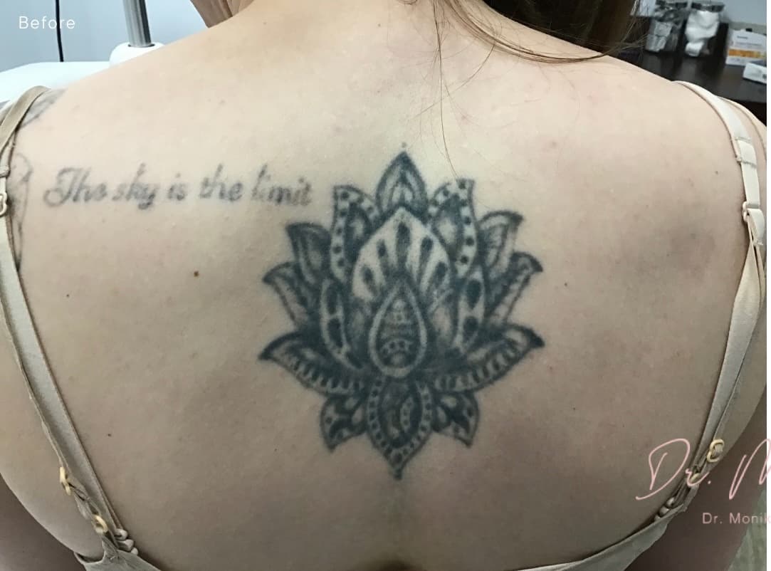 Before: Tattoo Removal Before & After Patient #1887