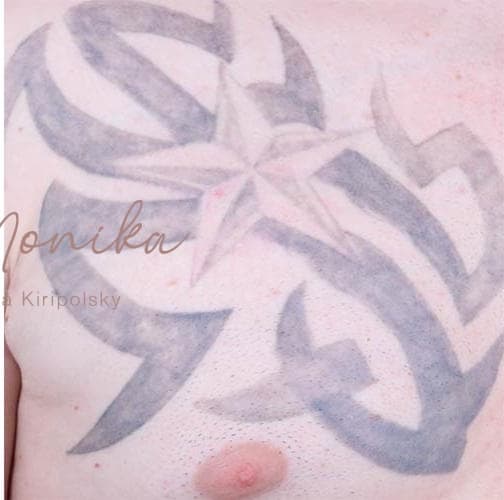 After: Tattoo Removal Before & After Patient #818
