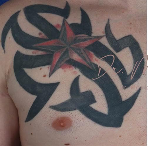 Before: Tattoo Removal Before & After Patient #818