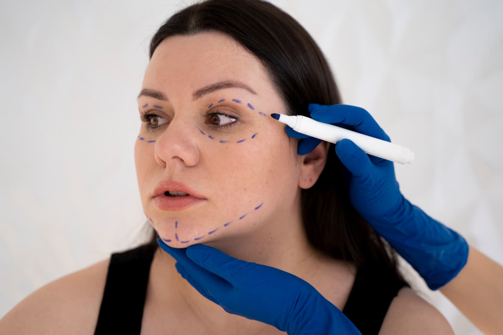 Lift lines marked on a woman's face before a thread lift