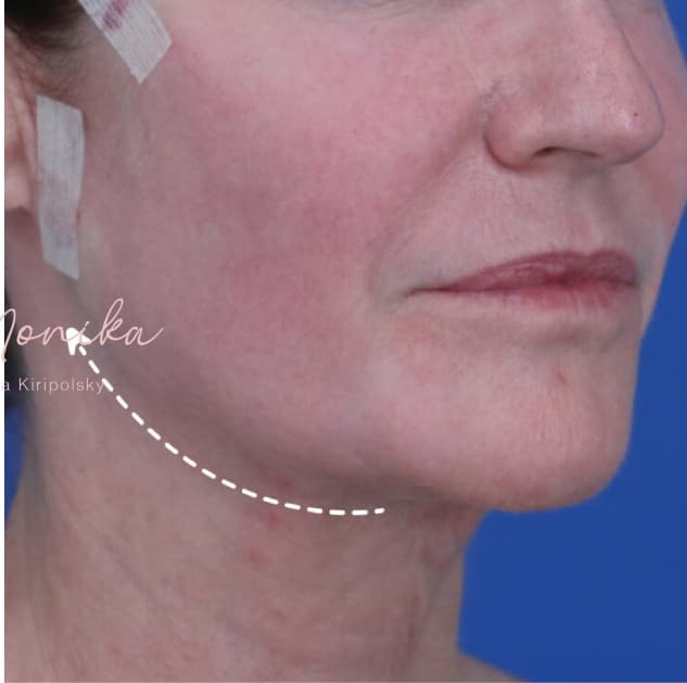 After: Thread Lifts Before & After Patient #1683