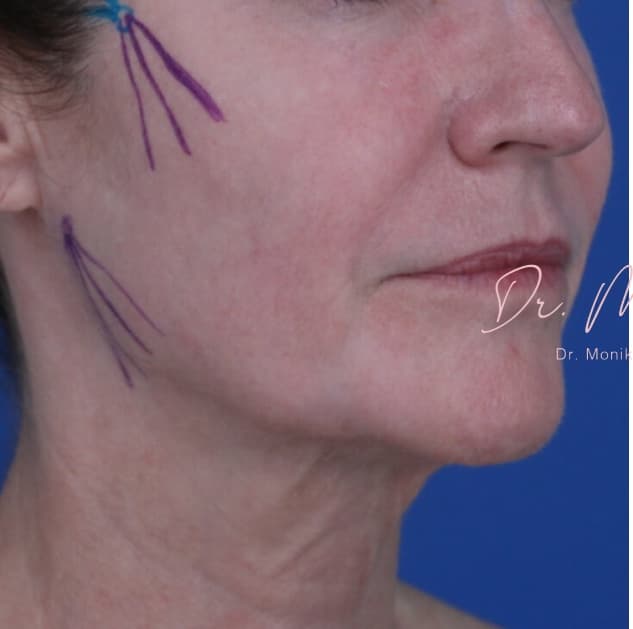 Before: Thread Lifts Before & After Patient #1683