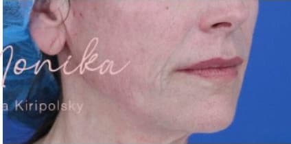 After: Thread Lifts Before & After Patient #659
