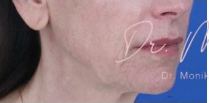 Before: Thread Lifts Before & After Patient #659