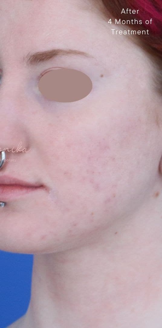 After: Acne Scarring Before & After Patient #1868
