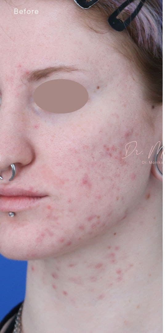 Before: Acne Scarring Before & After Patient #1868