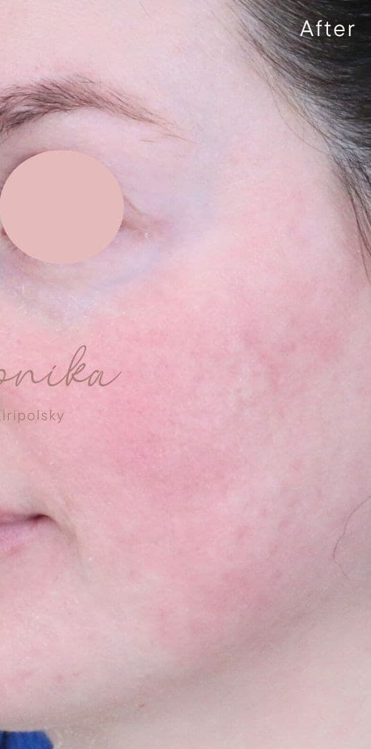 After: Acne Scarring Before & After Patient #1897