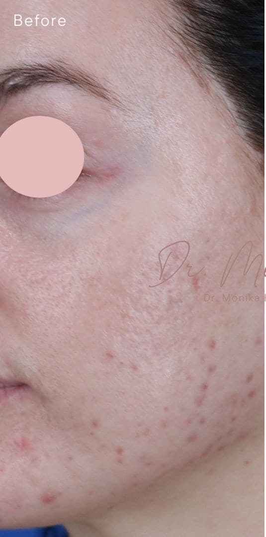 Before: Acne Scarring Before & After Patient #1897