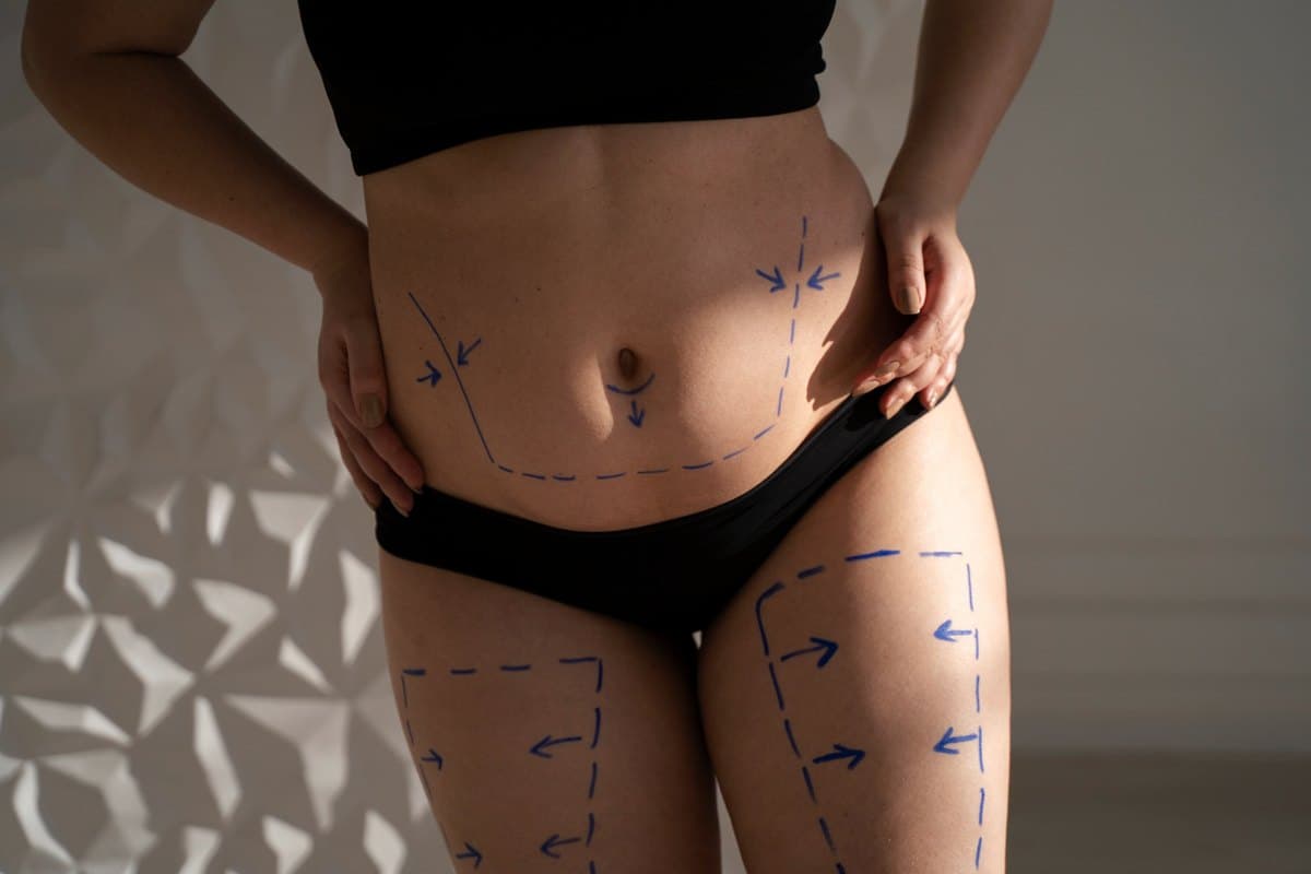 Treatment areas marked on the abdomen and thighs