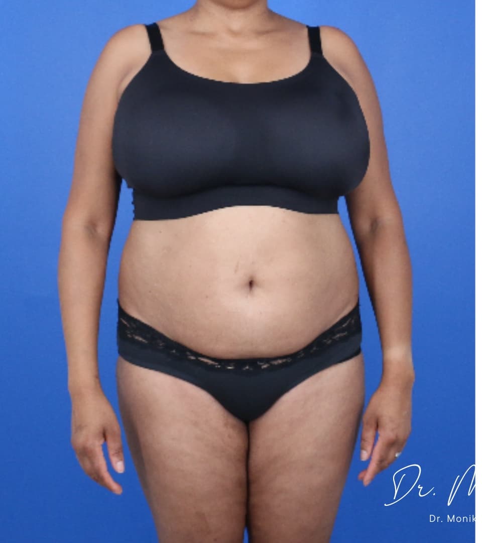 Before: GLP-1 Injections Before & After Patient #2184