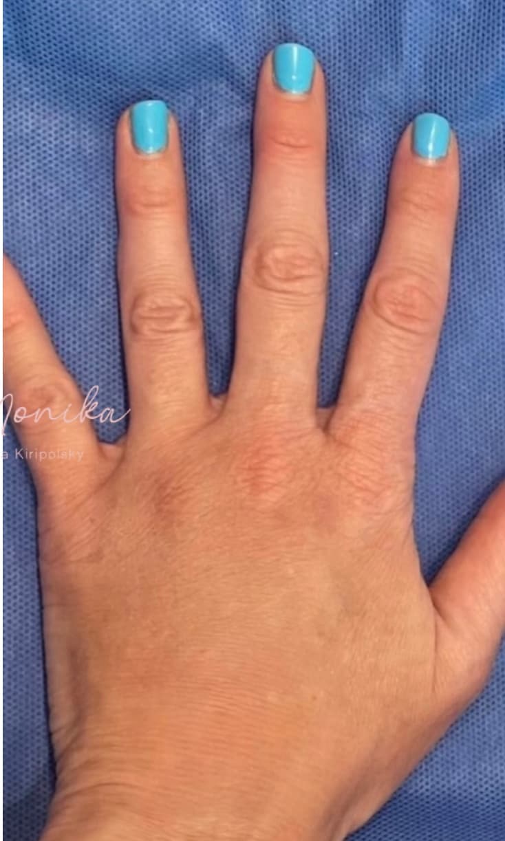 After: Hand Filler Before & After Patient #1762