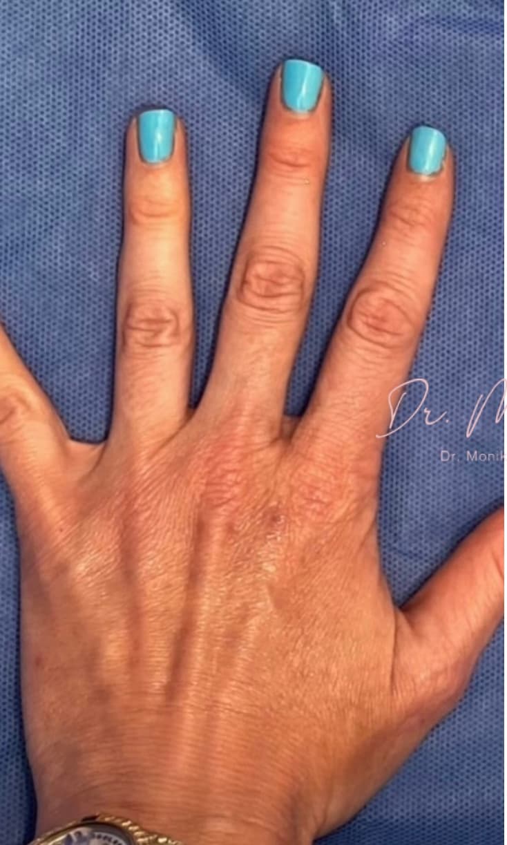 Before: Hand Filler Before & After Patient #1762