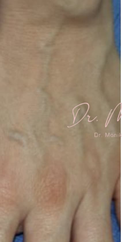 Before: Hand Filler Before & After Patient #549