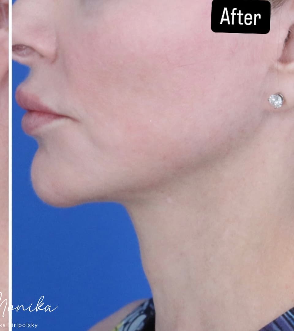 After: ResurFX Before & After Patient #2068