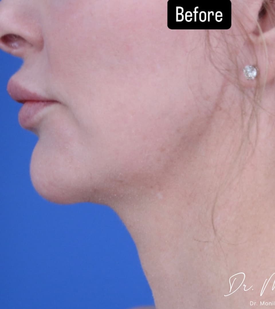 Before: ResurFX Before & After Patient #2068