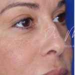 Filler Before & After Patient #530