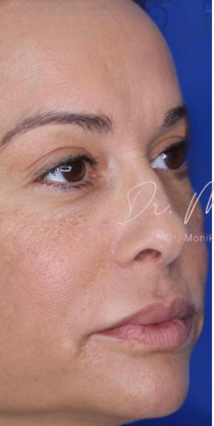 Filler Before & After Patient #530