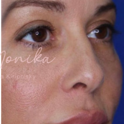 Filler Before & After Patient #530