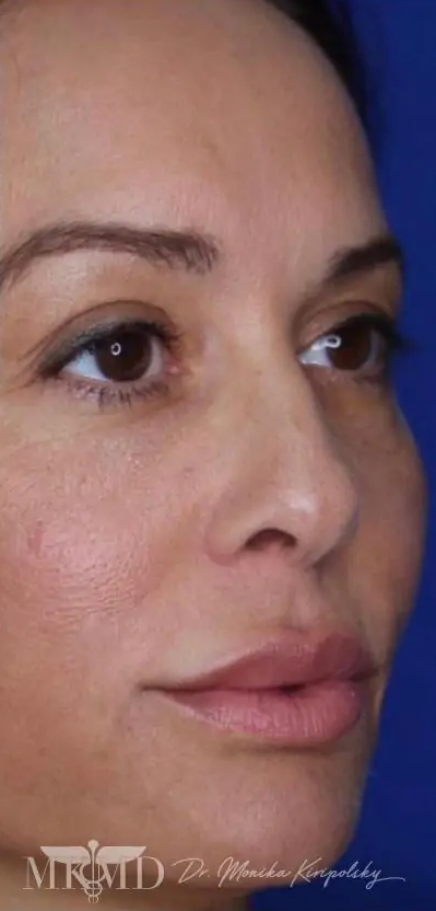 Juvederm Before & After Patient #530