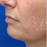 Filler Before & After Patient #533