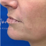 Filler Before & After Patient #533