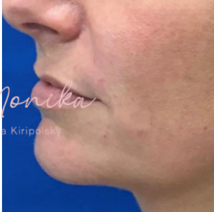 Filler Before & After Patient #533