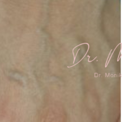 Hand Filler Before & After Patient #549
