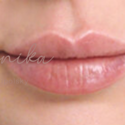 Lip Filler Before & After Patient #559