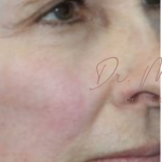 Chin & Jawline Facial Rebalancing Before & After Patient #579