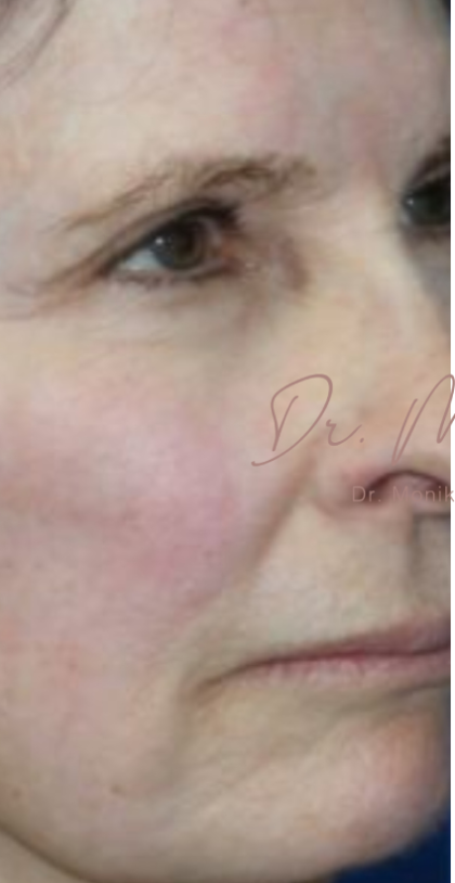 Chin & Jawline Facial Rebalancing Before & After Patient #579