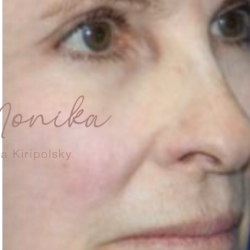 Chin & Jawline Facial Rebalancing Before & After Patient #579
