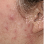 Acne Scarring Before & After Patient #621