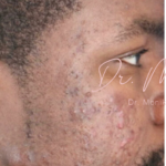 Acne Scarring Before & After Patient #624