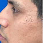 Acne Scarring Before & After Patient #637