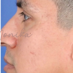 Acne Scarring Before & After Patient #637