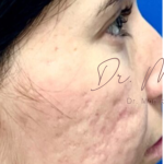 Acne Scarring Before & After Patient #638