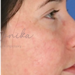 Acne Scarring Before & After Patient #638