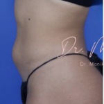 Liposuction / Liposculpture Before & After Patient #670