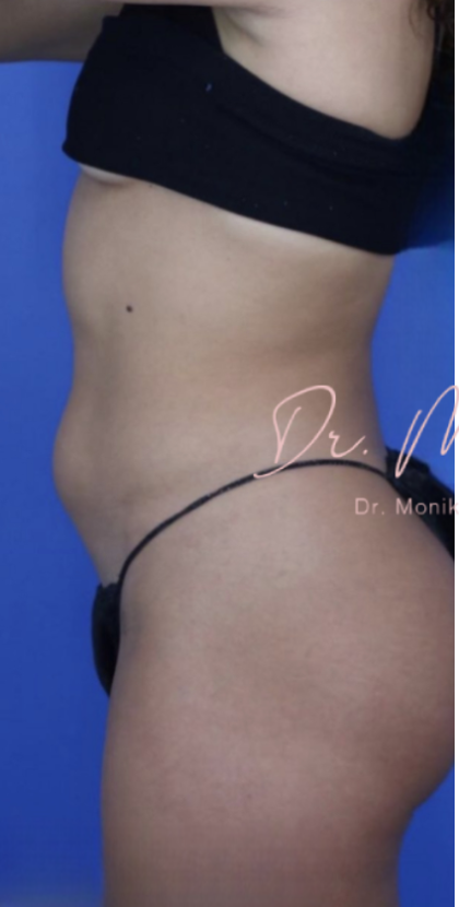 Liposuction / Liposculpture Before & After Patient #670