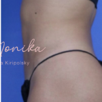 Liposuction / Liposculpture Before & After Patient #670