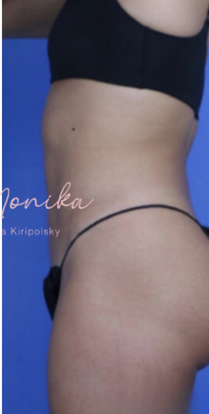 Liposuction / Liposculpture Before & After Patient #670