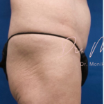 Liposuction / Liposculpture Before & After Patient #675