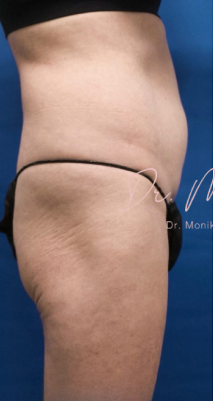 Liposuction / Liposculpture Before & After Patient #675