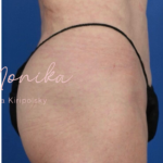 Liposuction / Liposculpture Before & After Patient #675