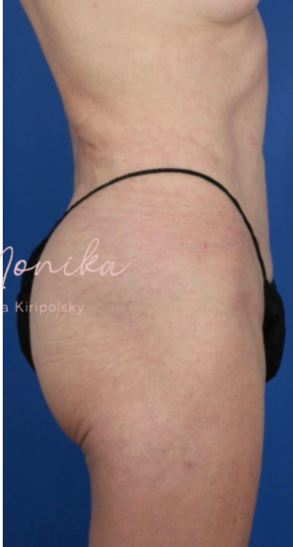 Liposuction / Liposculpture Before & After Patient #675