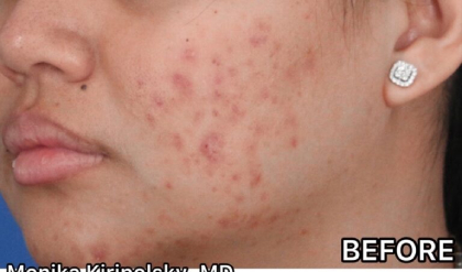 Acne Before & After Patient #623
